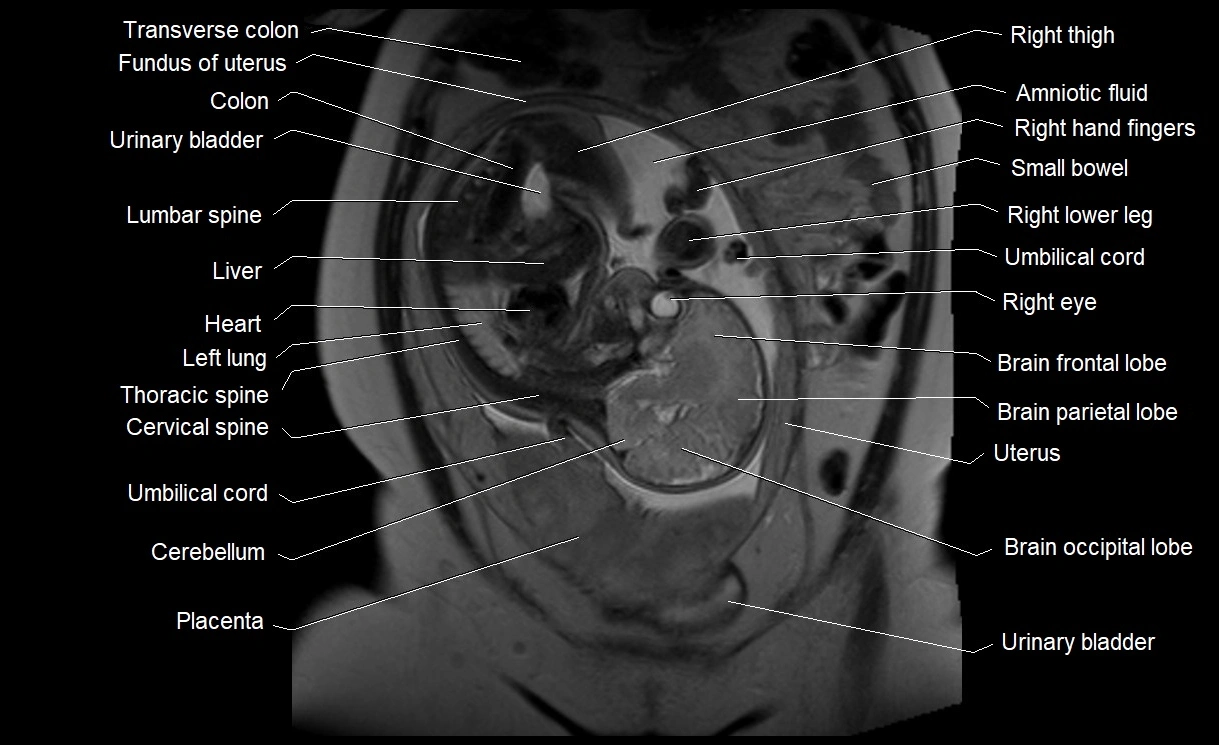 MRI Anatomy of pregnancy image 13.webp